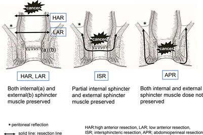 Comparison of long-term quality of life based on surgical procedure in patients with rectal cancer